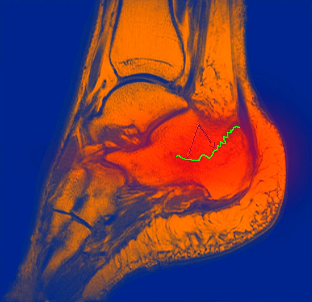 Foot, Fractured Calcaneum, X-Ray