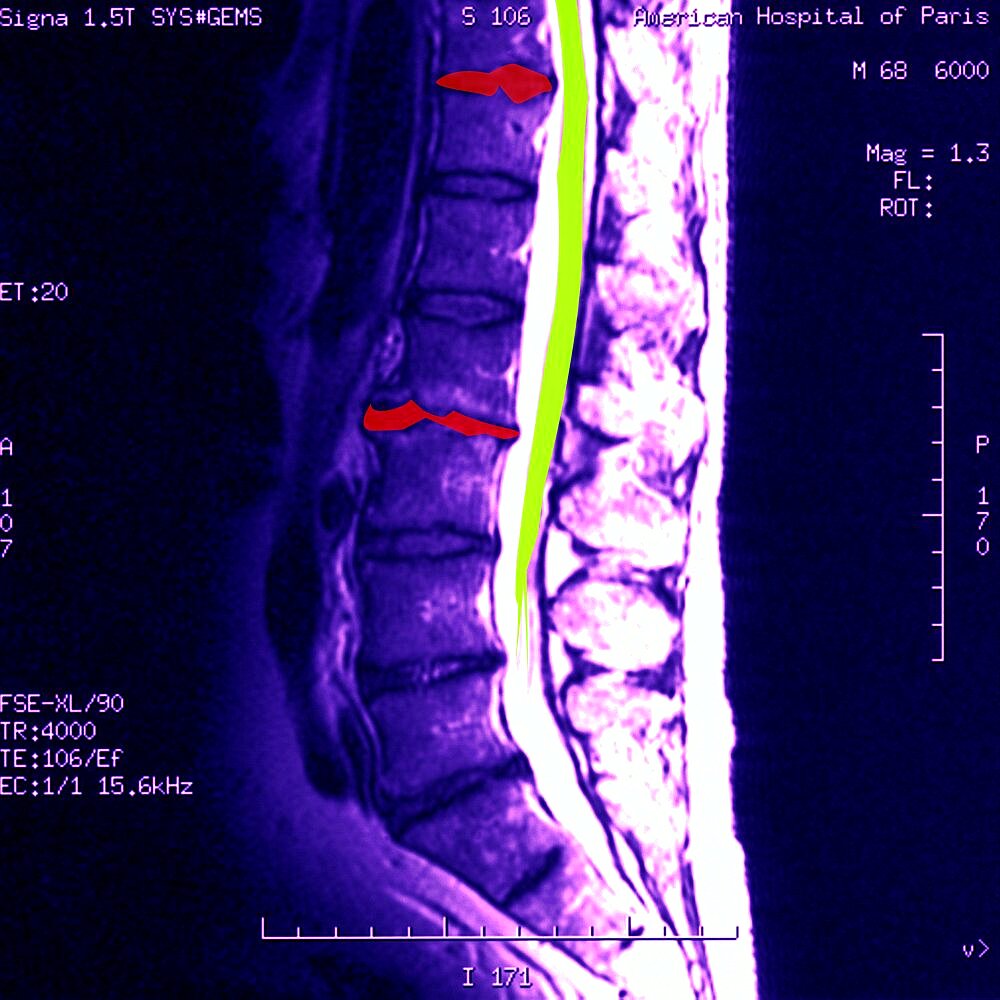 Vertebral Osteoarthritis, MRI