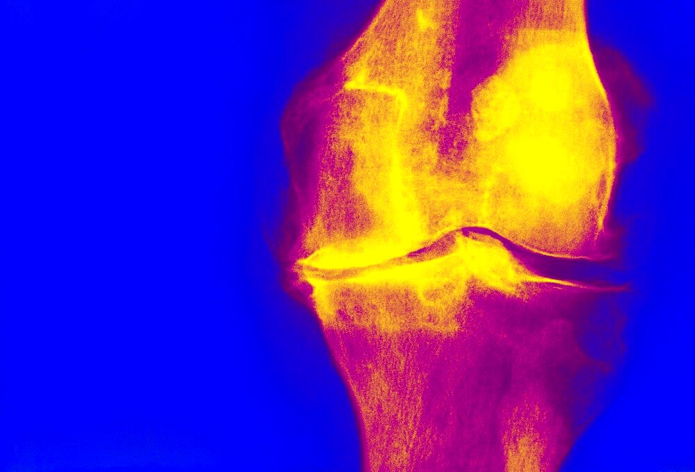 Knee Osteoarthritis, X-Ray