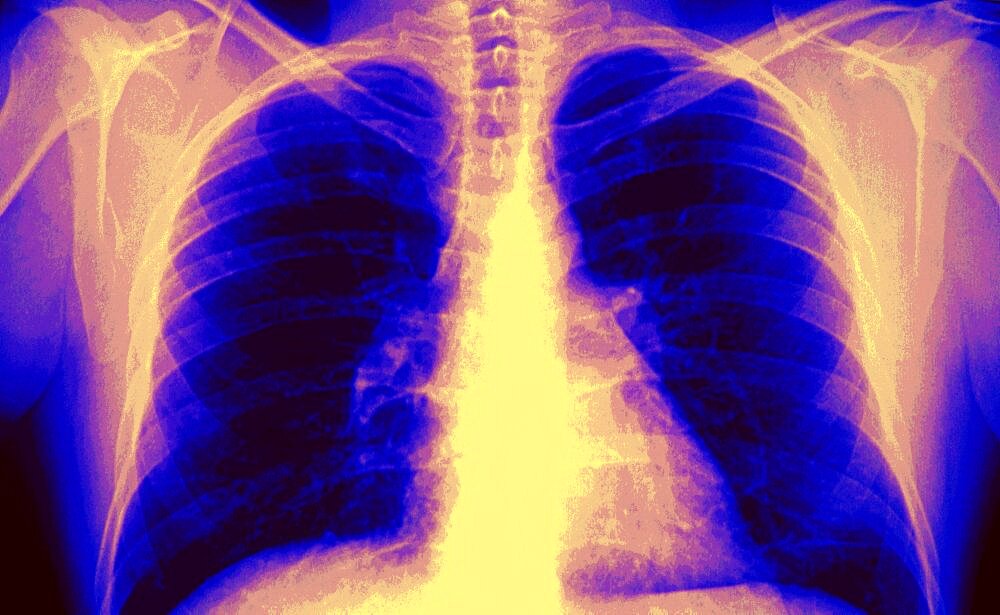 Lung, X-Ray, Normal