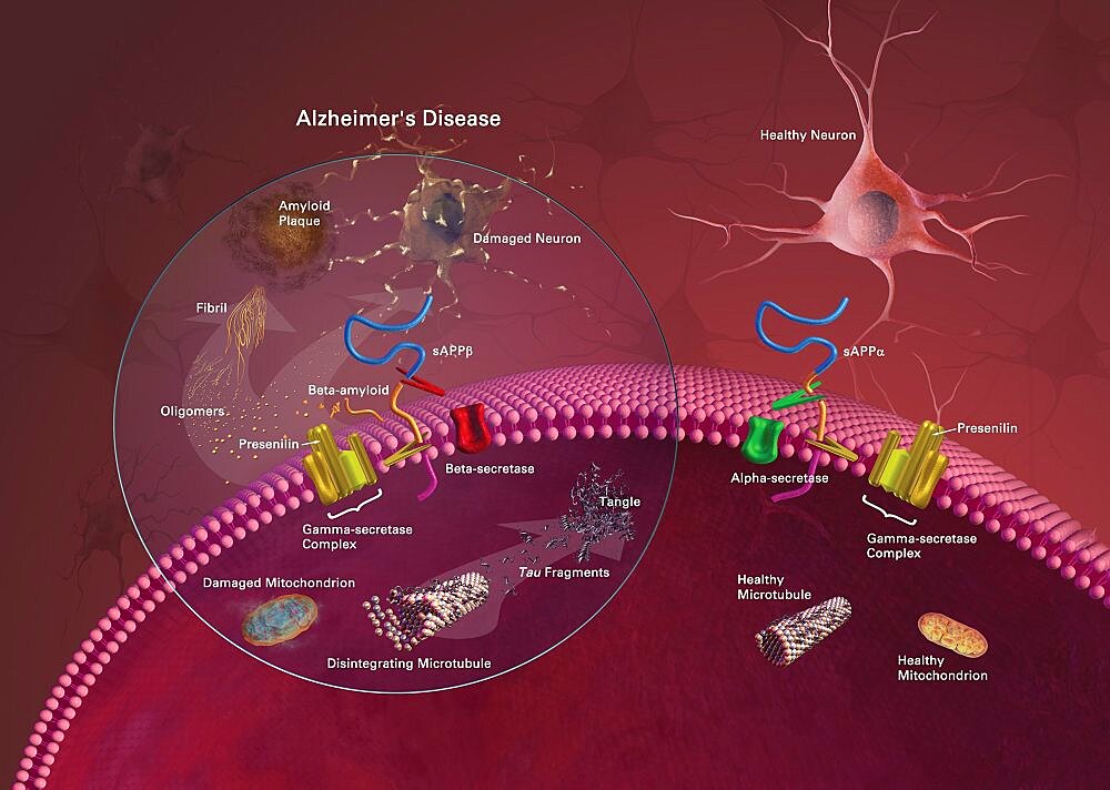 Alzheimer's Disease