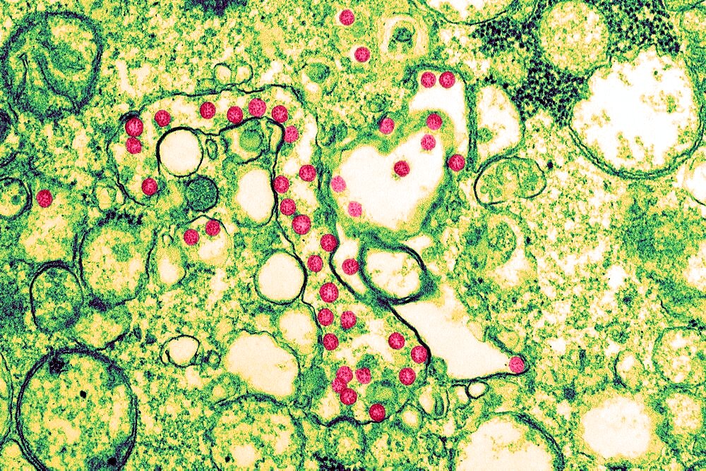 SARS-CoV-2, COVID-19 Virus, TEM