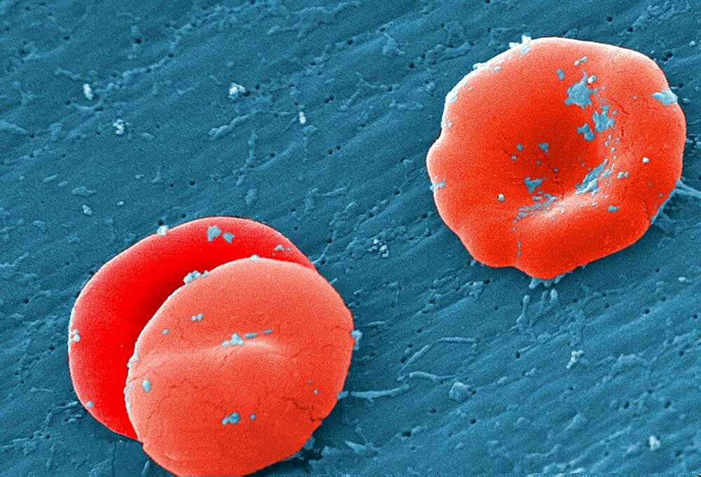 Sickle Cell Anemia, Human RBCs, SEM