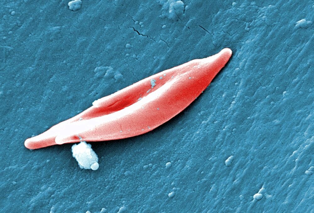 Sickle Cell Anemia, Human RBCs, SEM