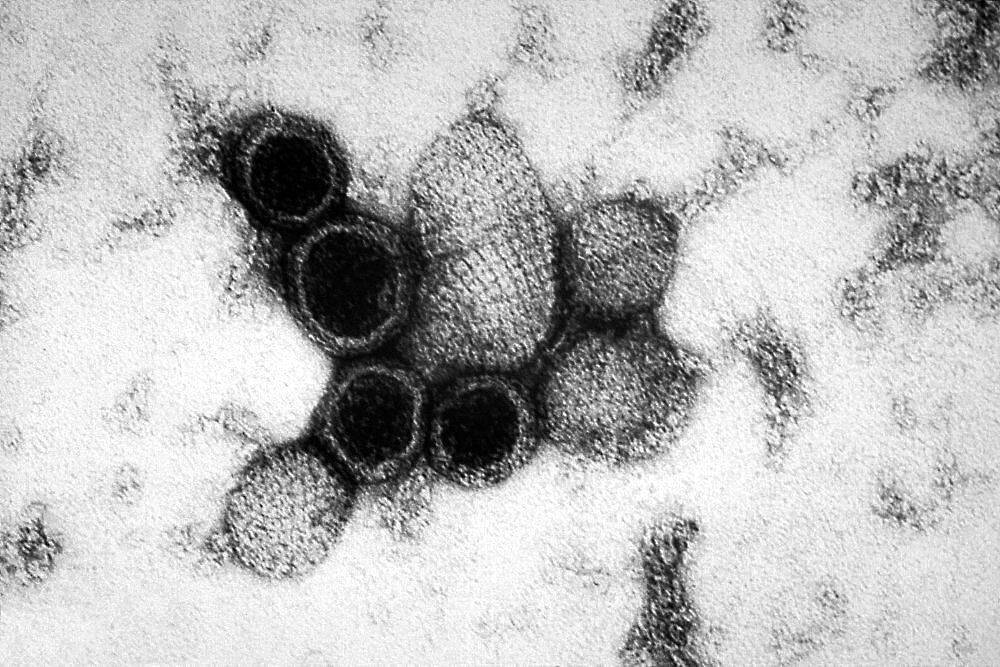 Hantavirus, Sin Nombre Virus, TEM