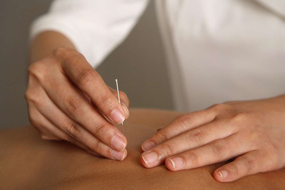 Acupuncture treatment, Chinese Medicine