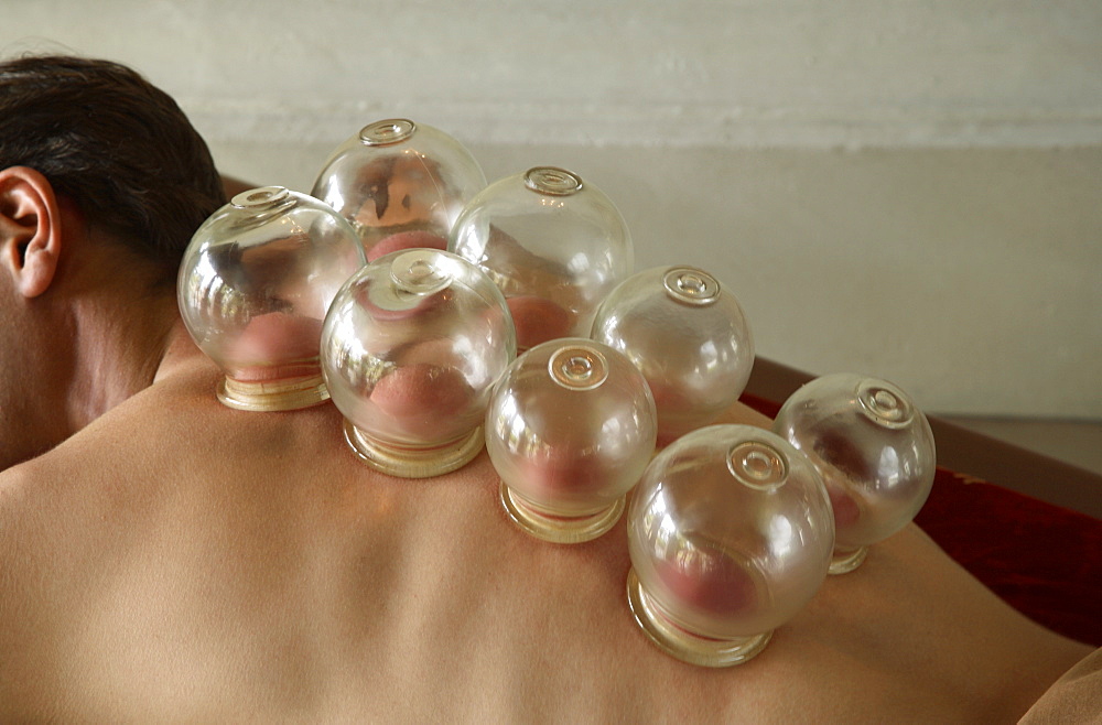 Chinese cupping, China, Asia
