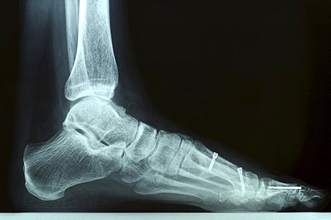 X-ray photo of a left foot after bunion surgery with screws and other hardware