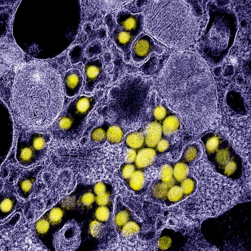 Novel coronavirus sars-cov-2