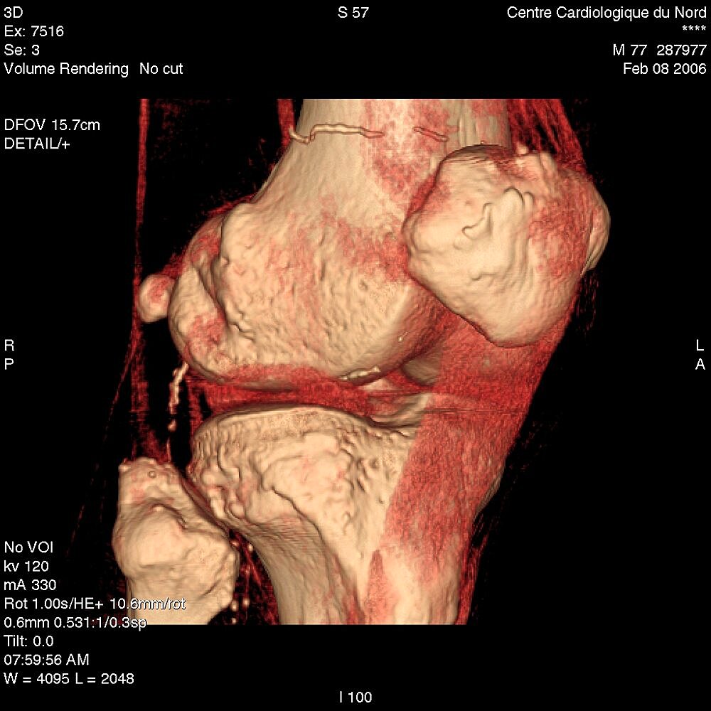 Knee, 3D Scan