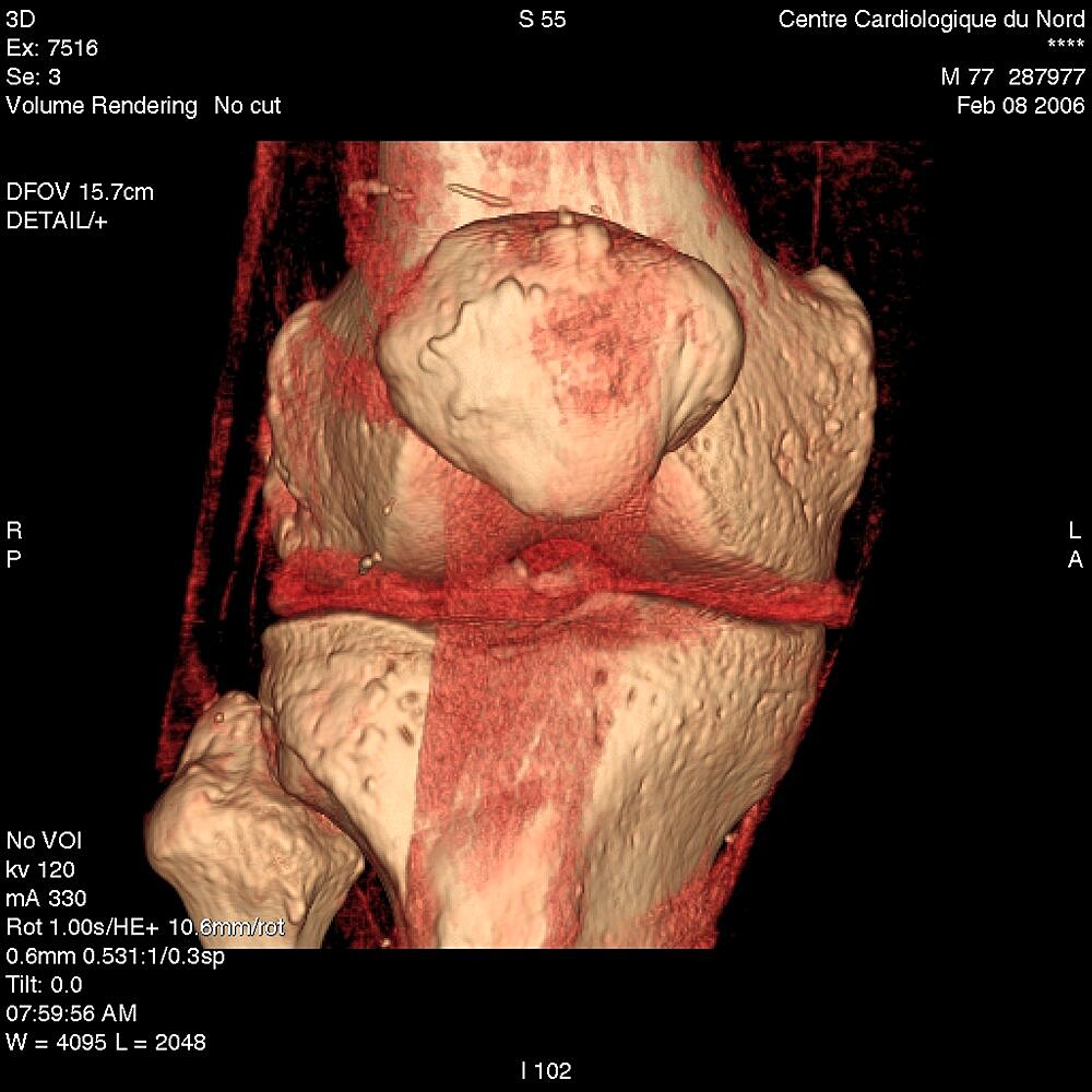 Knee, 3D Scan