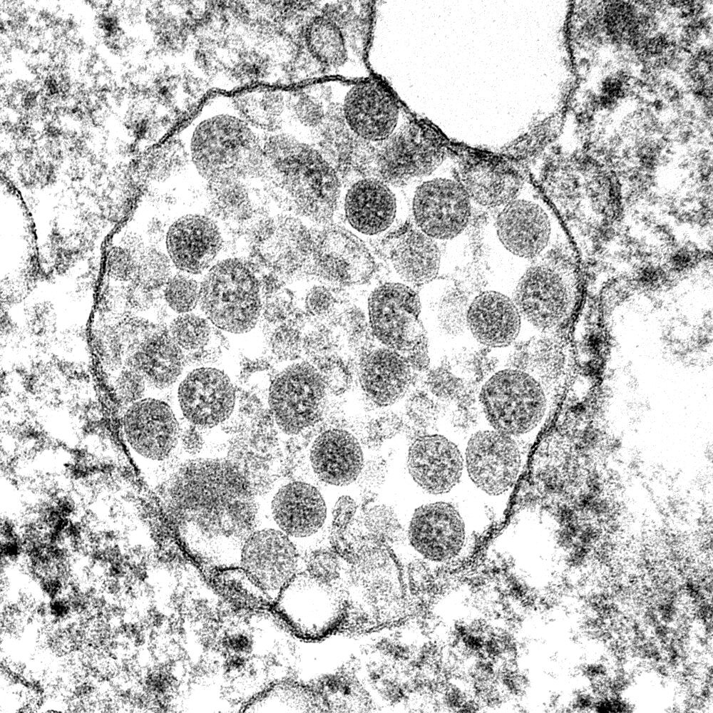 SARS-CoV-2, COVID-19 Virus, TEM