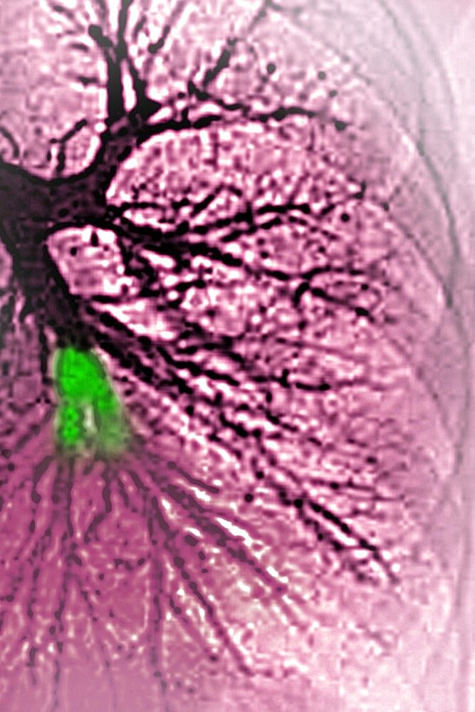 Pulmonary embolism