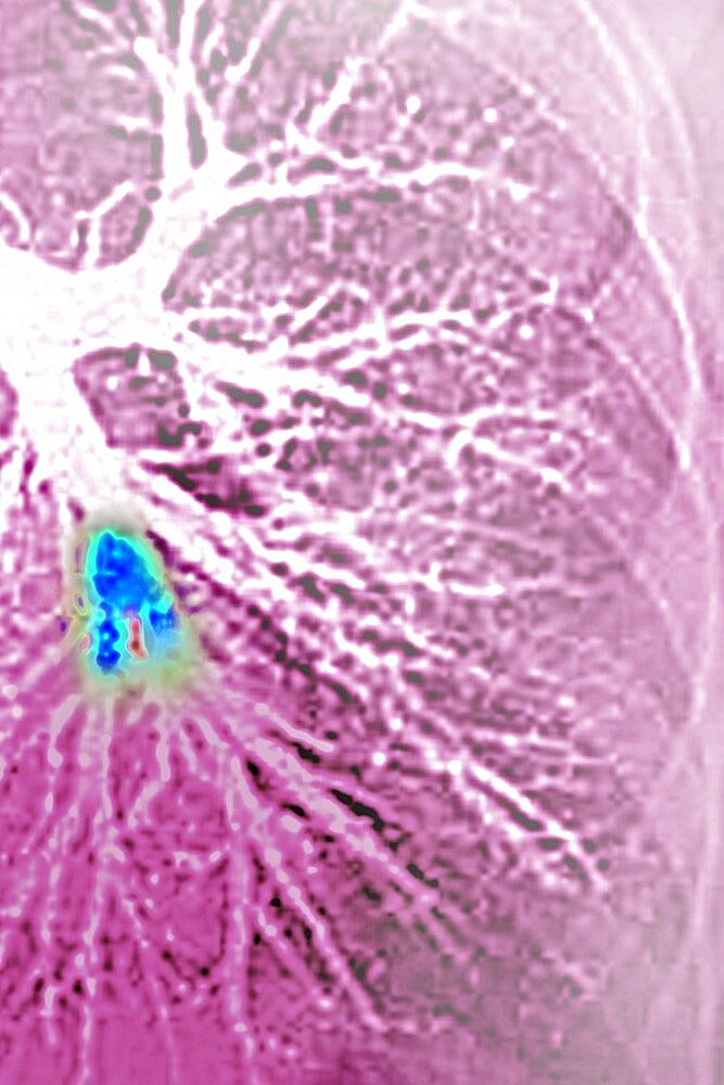 Pulmonary embolism