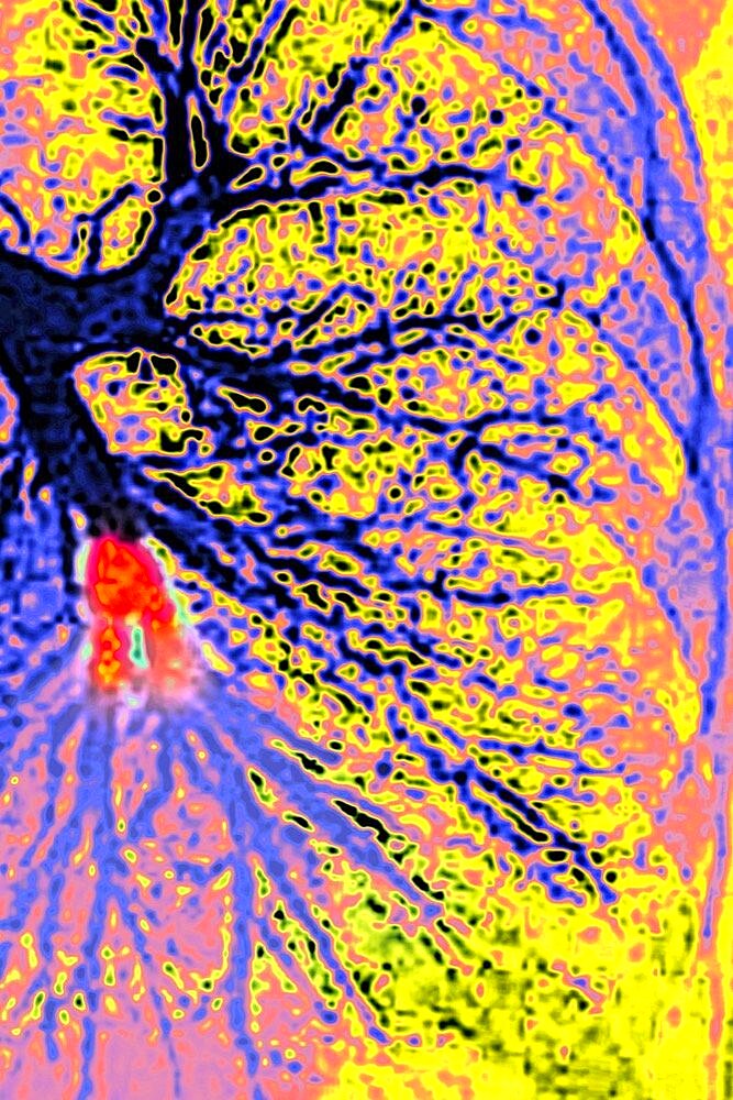 Pulmonary embolism