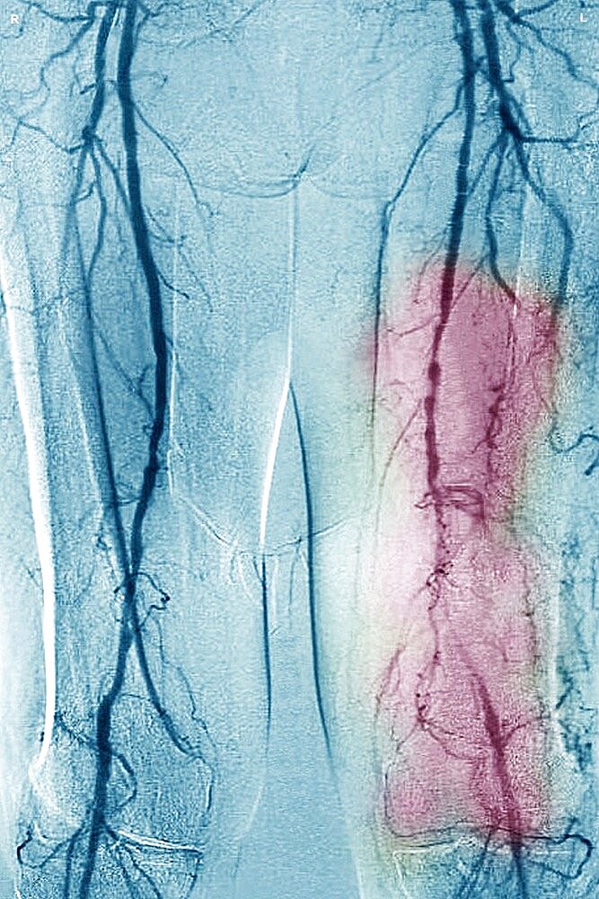 Obliterating arterial disease of the lower limbs