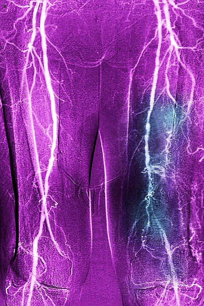 Obliterating arterial disease of the lower limbs