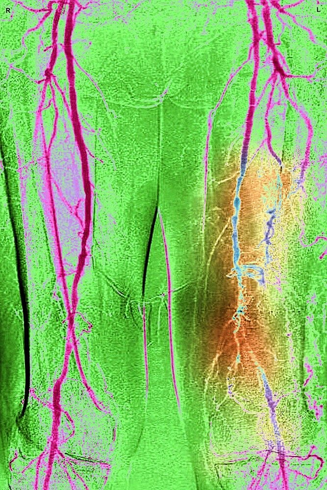 Obliterating arterial disease of the lower limbs