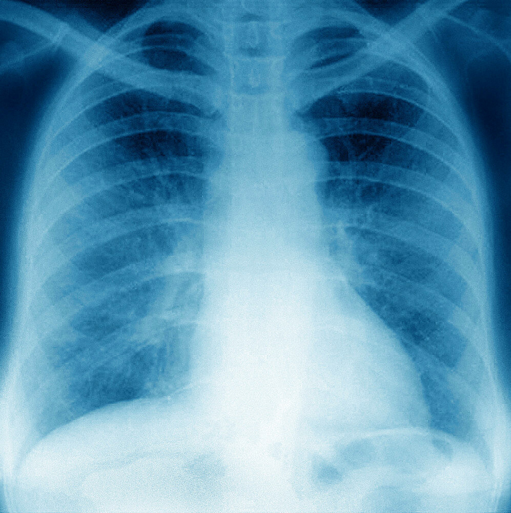 Pneumonia with radiological appearance in frosted glass