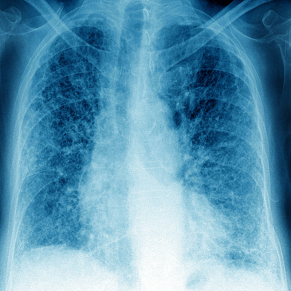 Pulmonary fibrosis (lesion of the lungs characterized by the presence of excess fibrous connective tissue), chest x-ray.