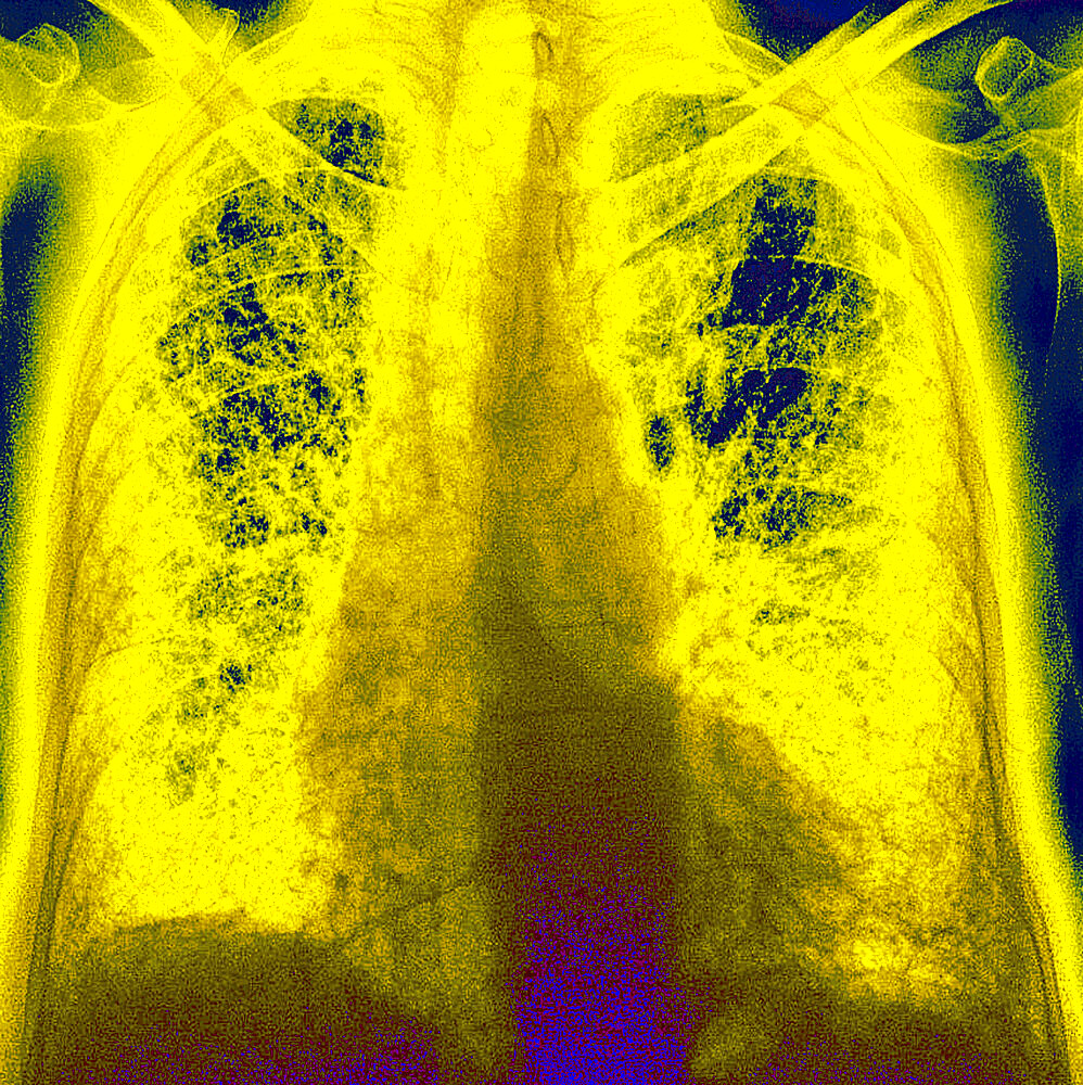 Pulmonary fibrosis (lesion of the lungs characterized by the presence of excess fibrous connective tissue), chest x-ray.