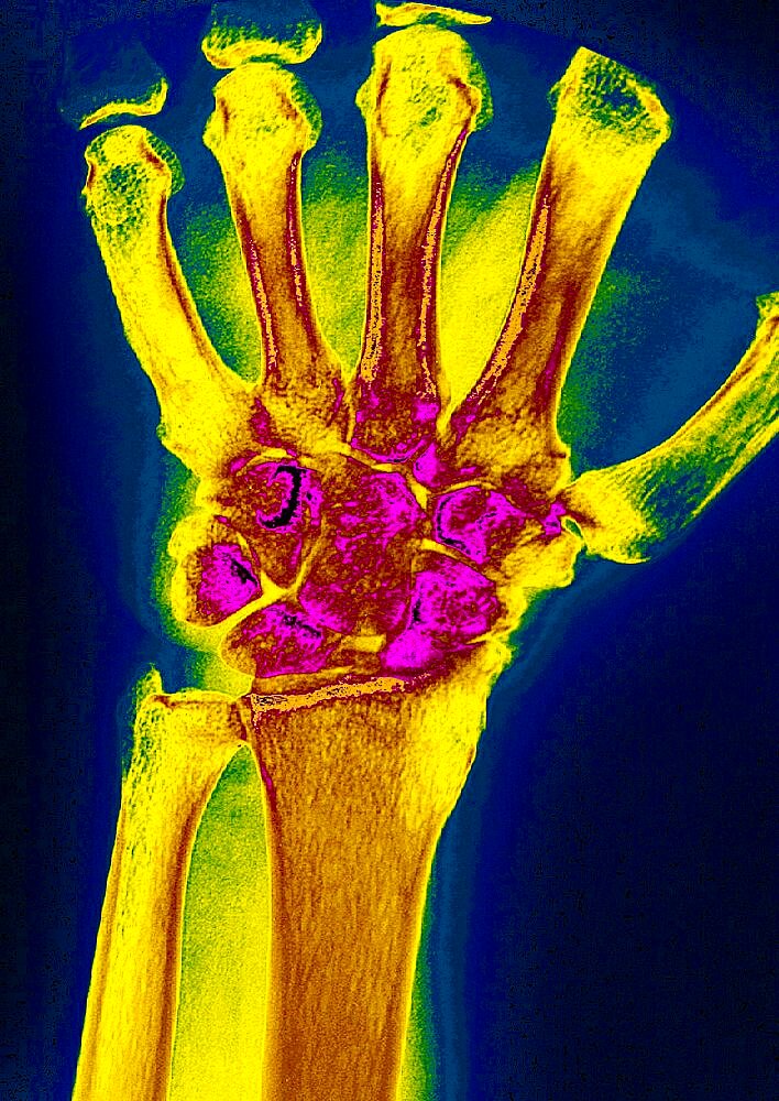 Wrist Osteoarthritis, X-Ray