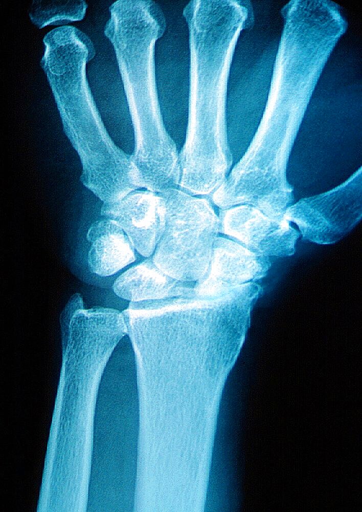 Wrist Osteoarthritis, X-Ray