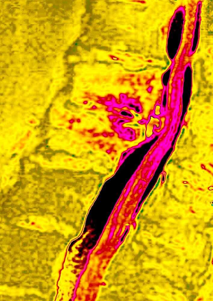 Spondylodiscitis, MRI