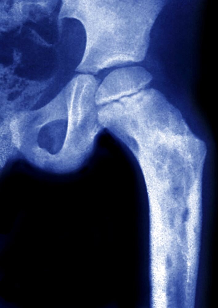 Osteomyelitis