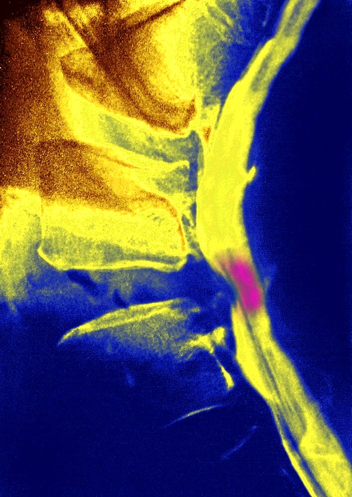 Herniated Disk, X-Ray