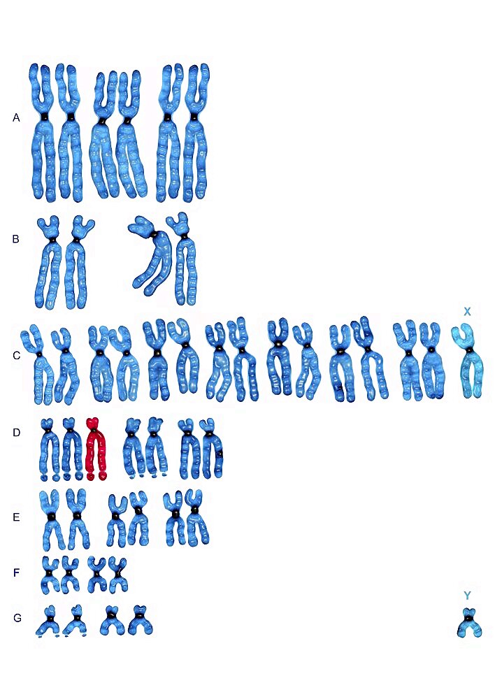 Trisomy 13