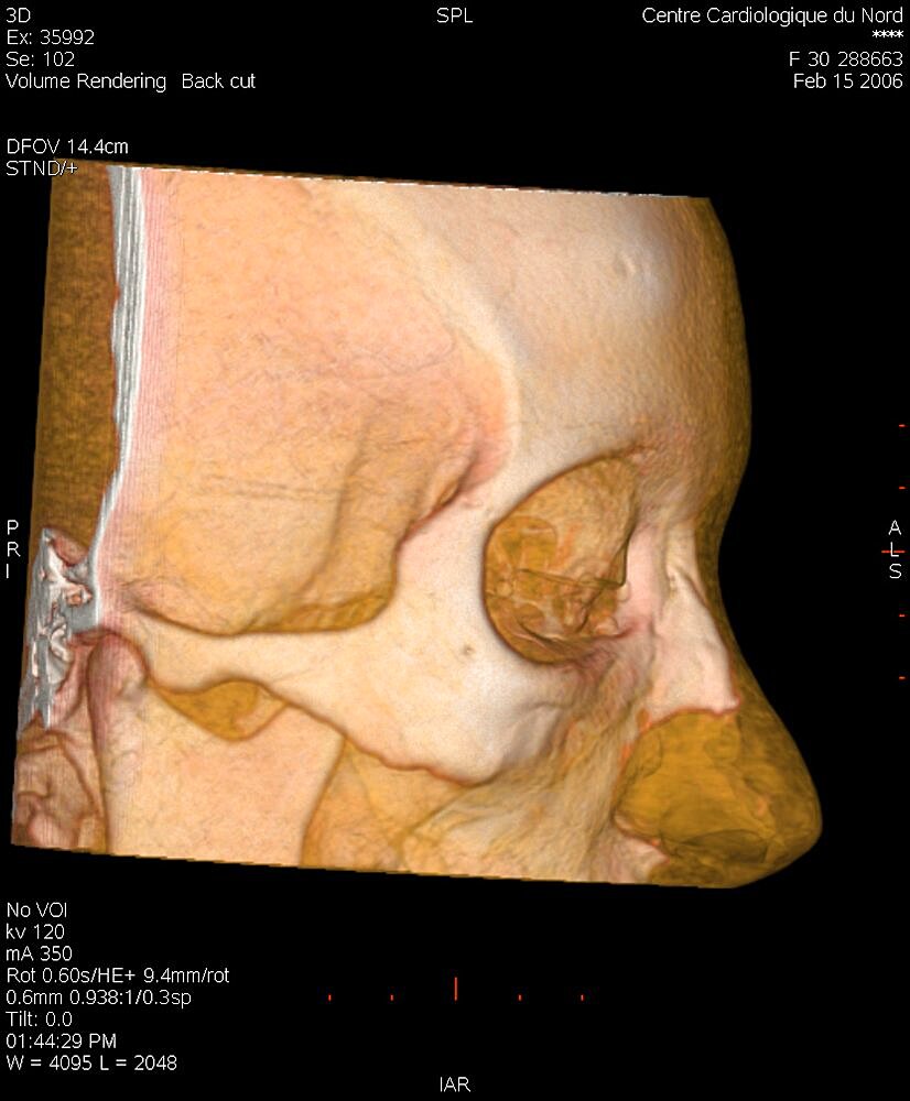 Fractured Nose, 3D Scan