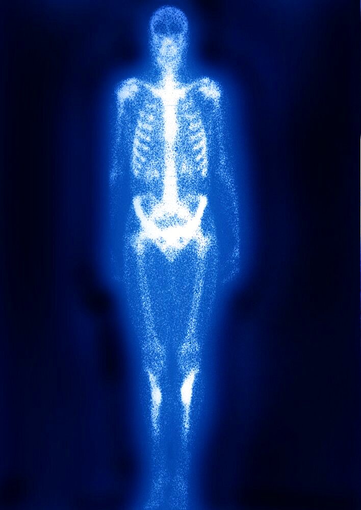 Fatigue Fracture, Scintiscan