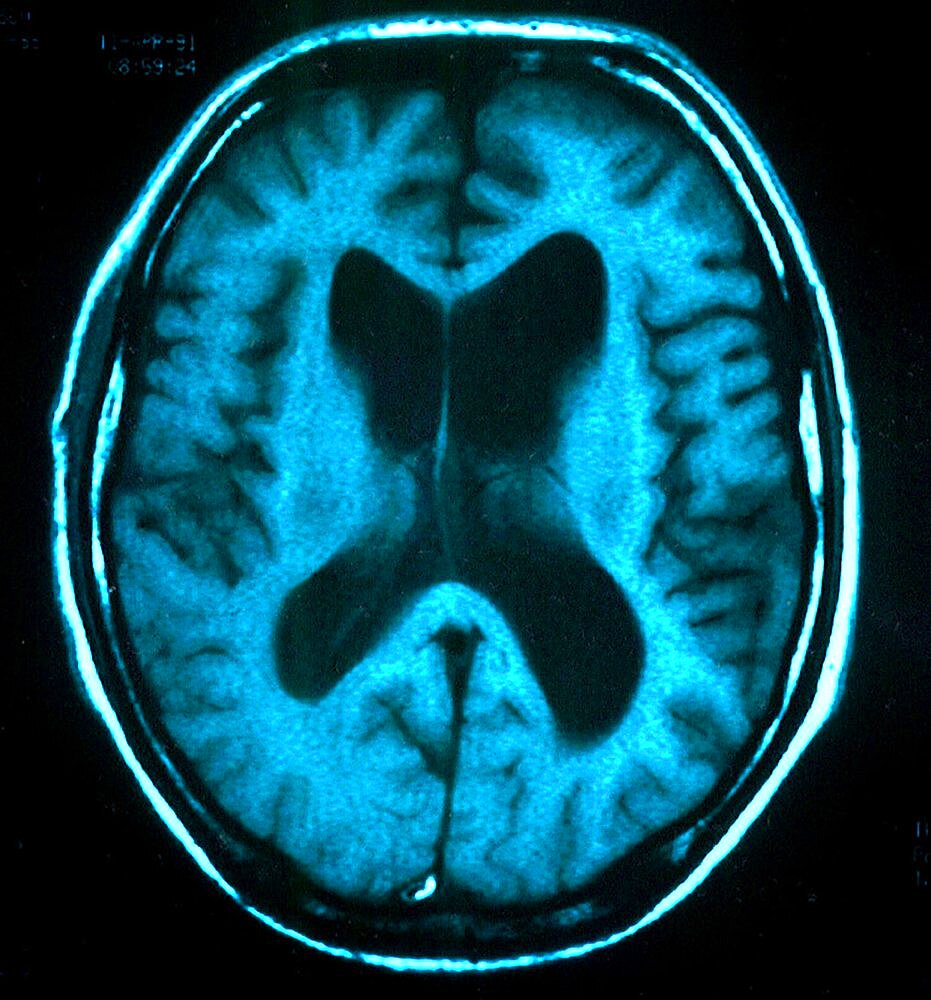 Hydrocephalus, Scan