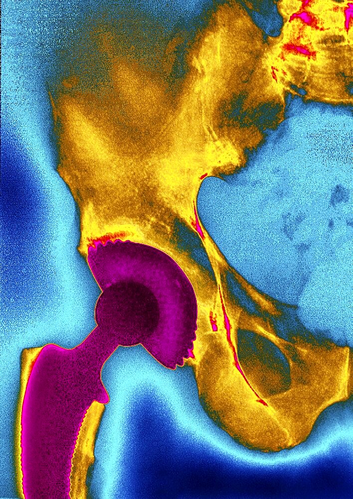 Hip Prosthesis,  X-Ray