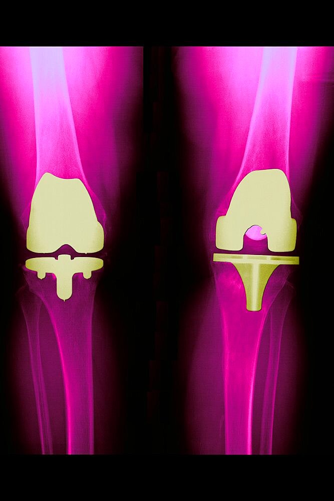 Knee Prosthesis,  X-Ray