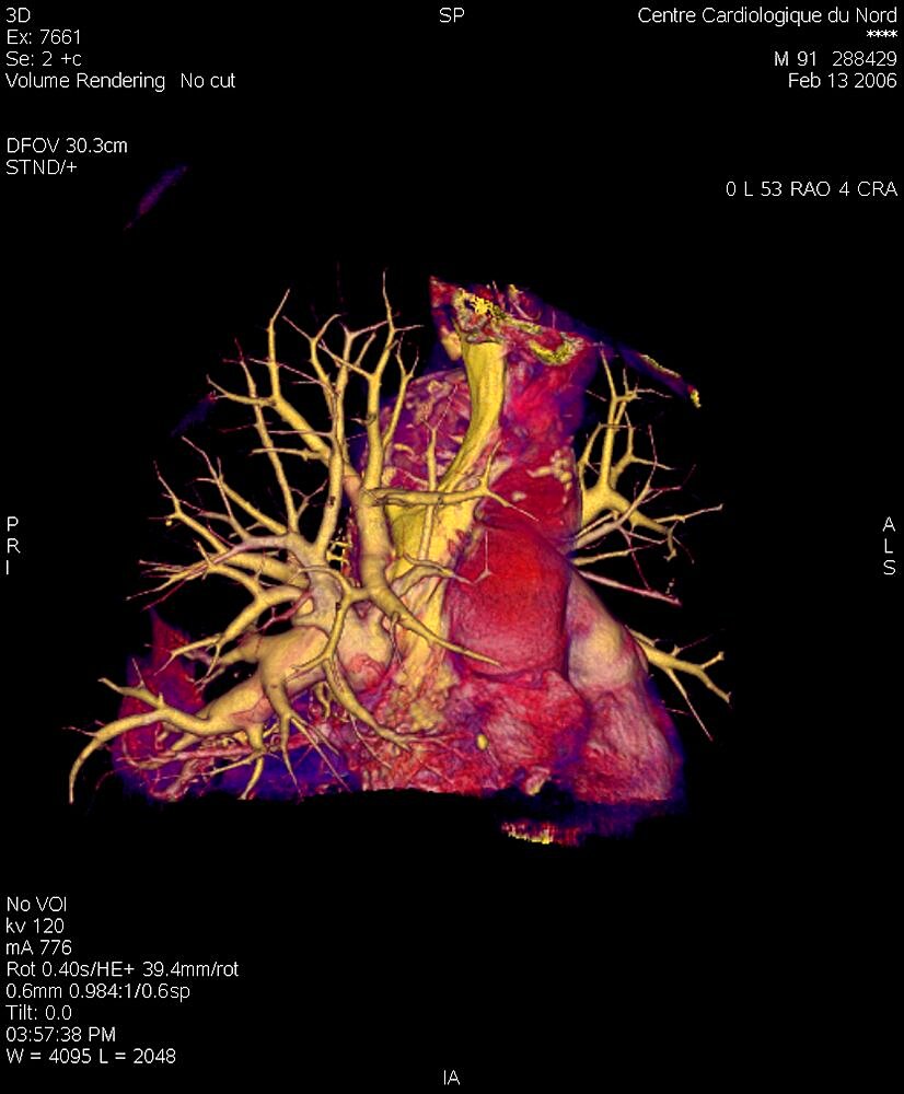 Pulmonary Artery, 3D Scan