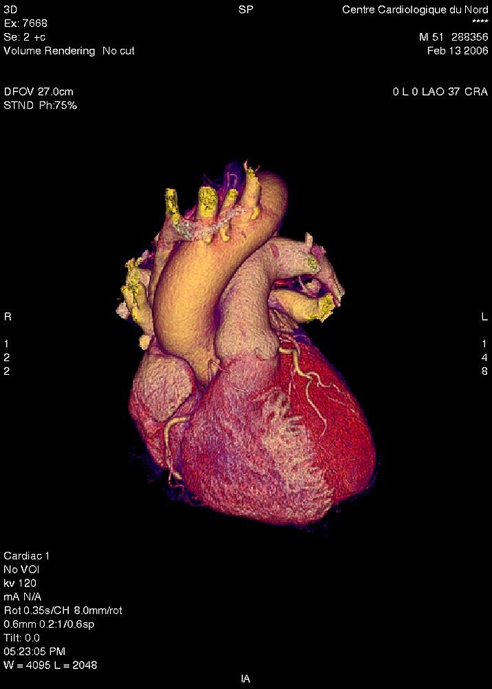 Heart, 3D Scan