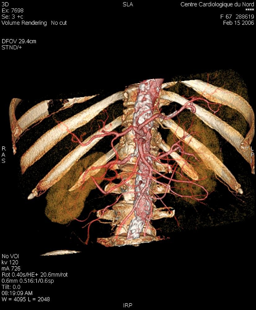 Kidney Artery, 3D Scan