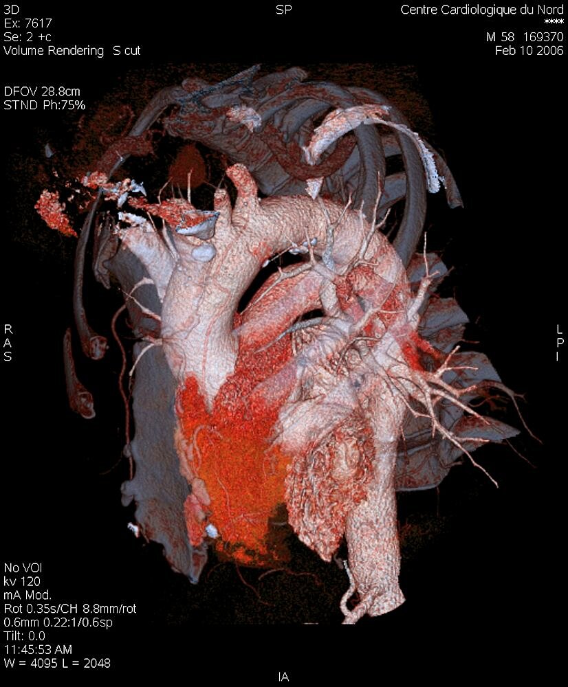 Aorta, 3D Scan