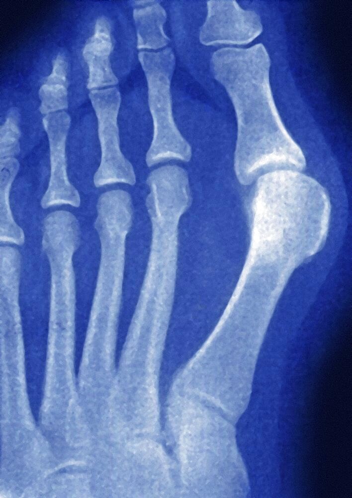 Hallux Valgus, X-Ray