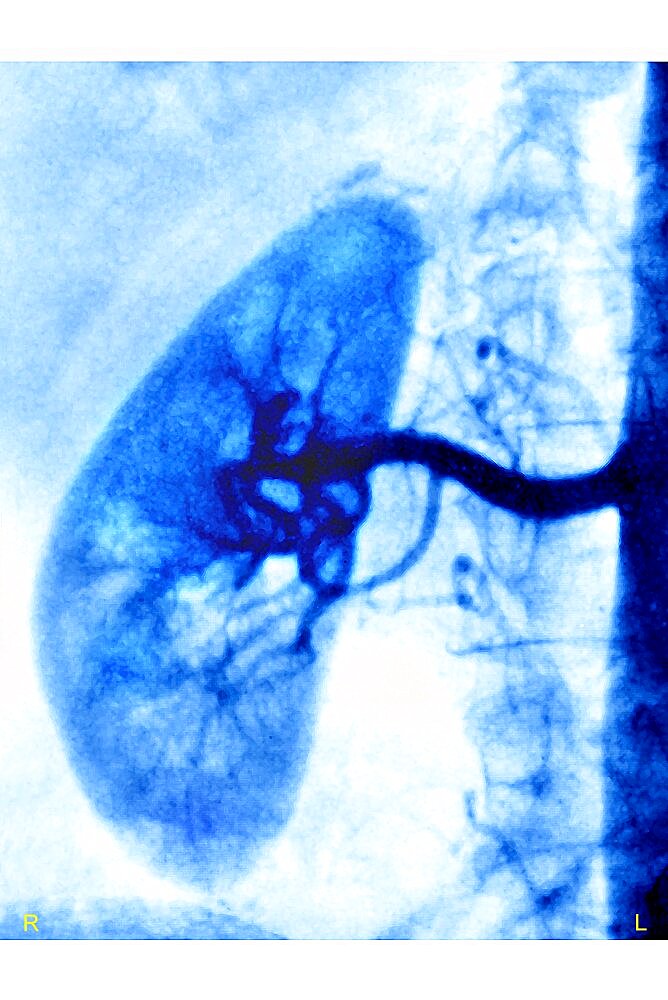 Kidney, Angiography Result