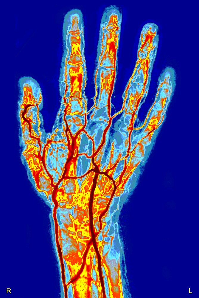 Hand, Arteriography