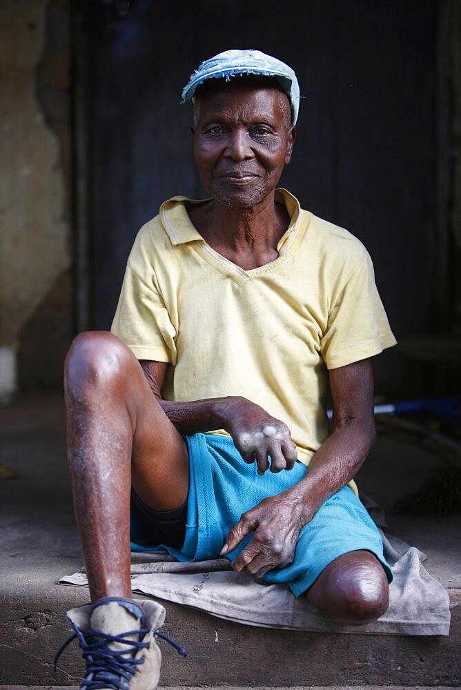 Person Suffering From Leprosy