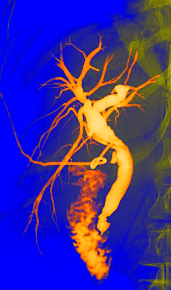 Cholangiography