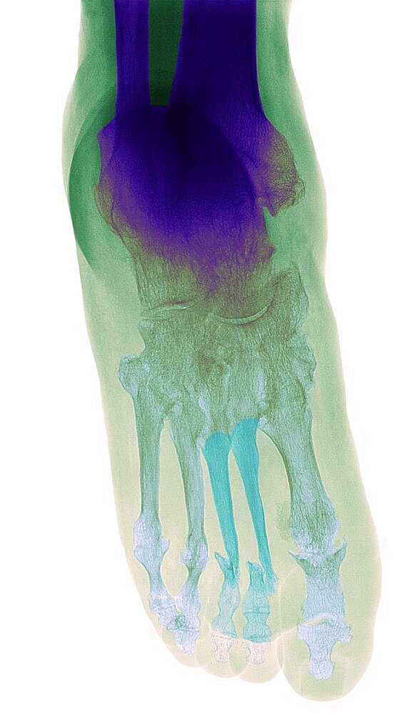 Colorized X-ray image of psoriatic rheumatism