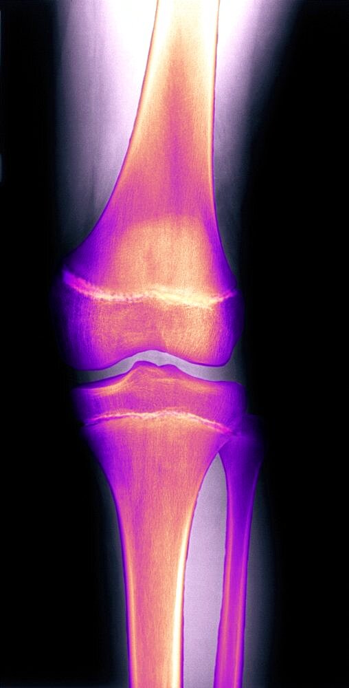 Colorized X-ray image of knee