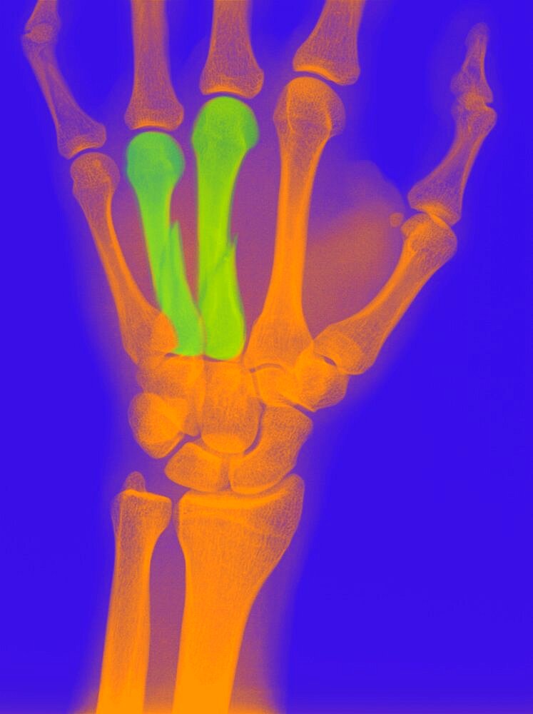 Fractured Finger, X-Ray