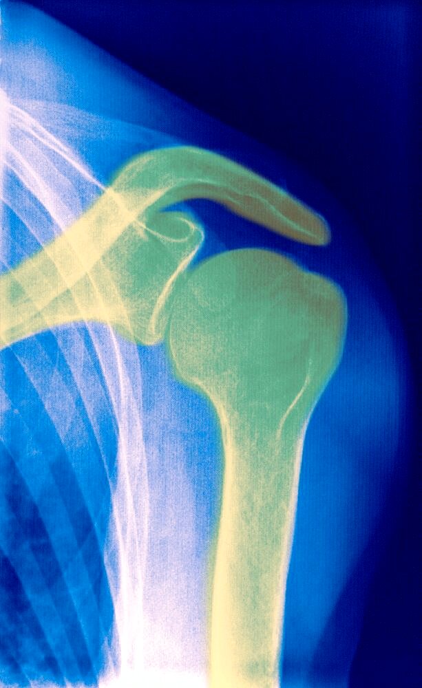Shoulder, X-Ray