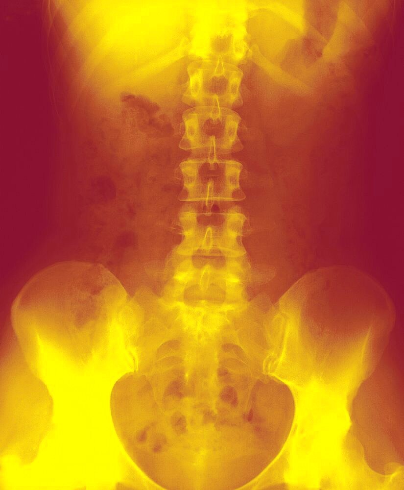 Spinal Column, X-Ray